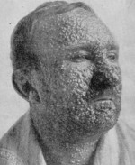 Image of smallpox victim cc0