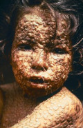 Image of smallpox victim cc0